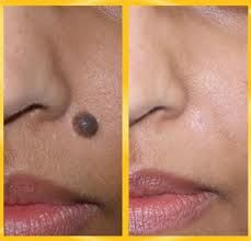 clear skin tags